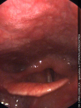 Endoscopia nasale e laringea 1